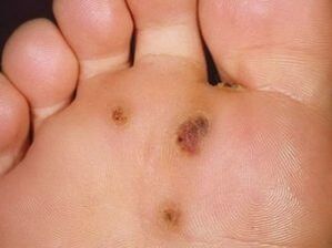 Como desfacerse dunha verruga plantar