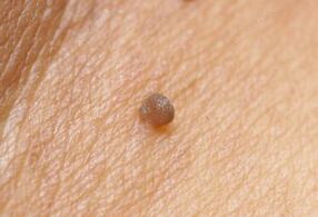 Imaxe clínica de papiloma