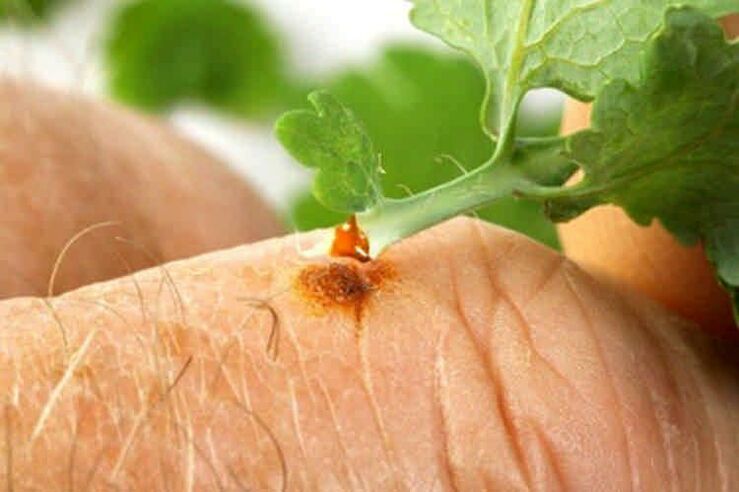 Como eliminar papilomas con remedios populares