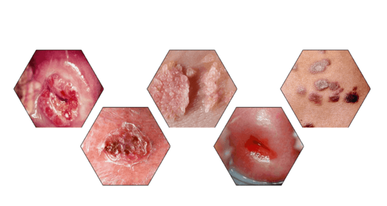 Por que os papilomas son perigosos