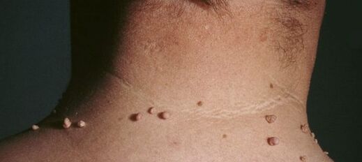 como desfacerse dos papilomas