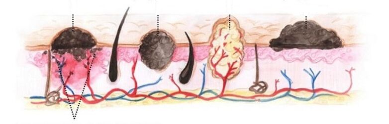 tipos de papilomas no corpo humano