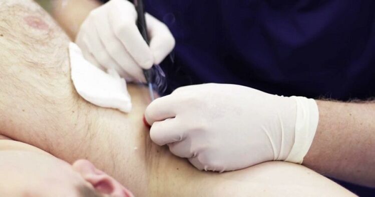 métodos profesionais para eliminar papilomas do corpo humano