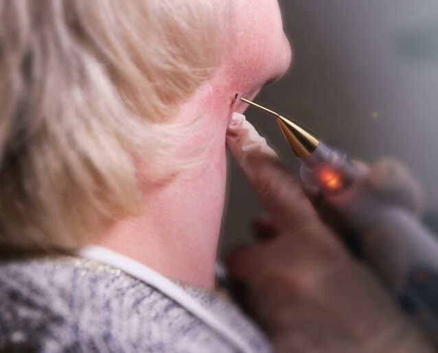 O proceso de eliminación do papiloma do pescozo dunha muller