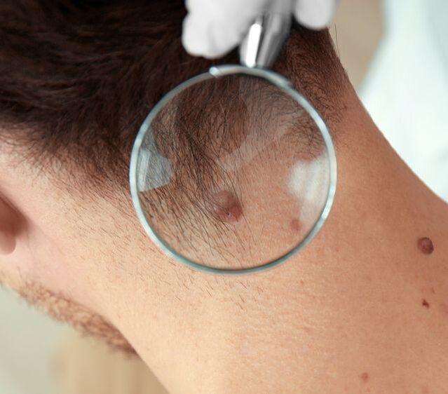 Un médico examina un papiloma no pescozo