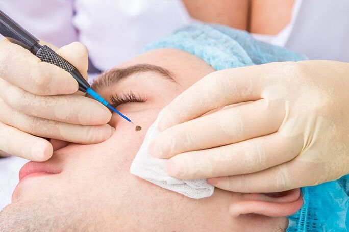 eliminación do papiloma da cara debido ao virus do papiloma humano