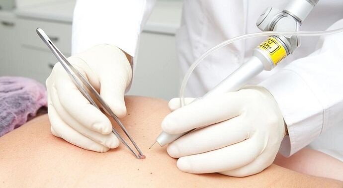 extirpación láser de papiloma para o virus do papiloma